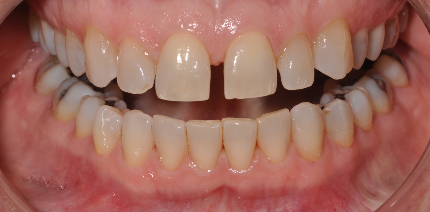 Cosmetic Bonding Halifax, NS Dr. Jenine Arab Omalley